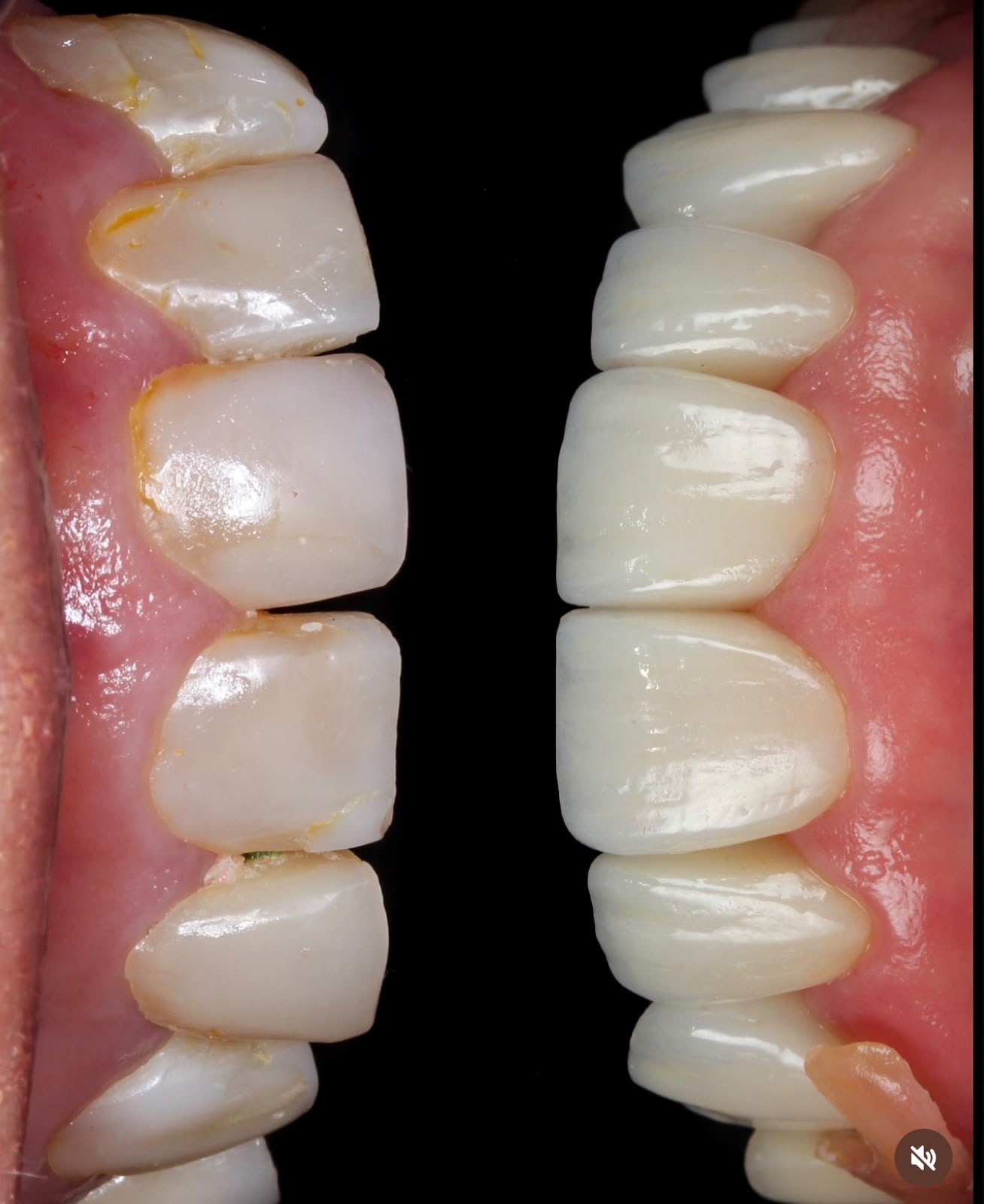 Antes y después — Diseño de sonrisa